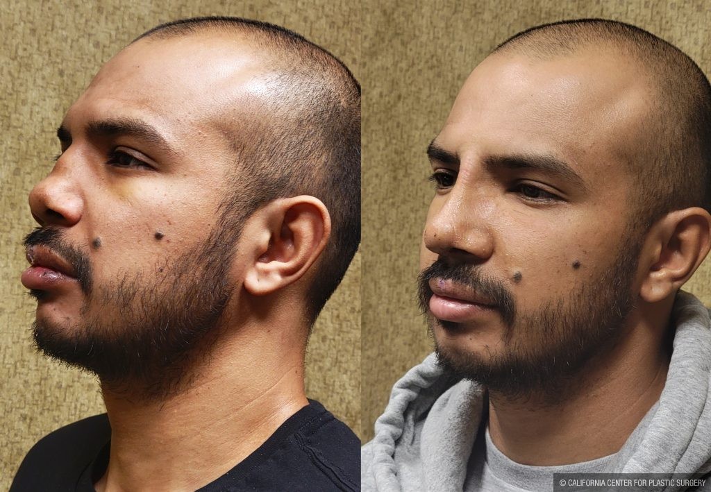 Rhinoplasty - Hispanic Before & After Patient #14119