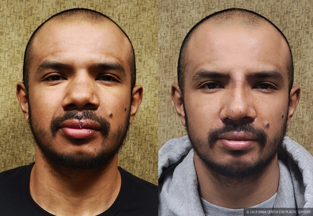 Rhinoplasty - Hispanic Before & After Patient #14119