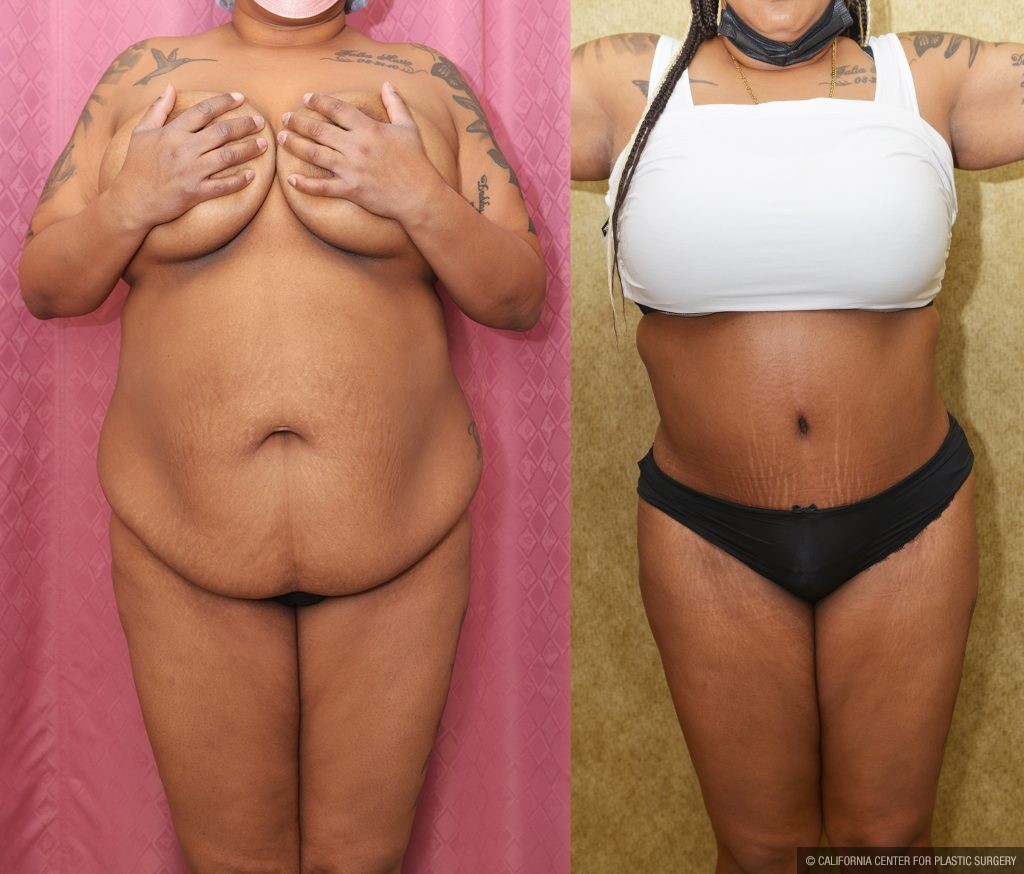 African American Tummy Tuck (Abdominoplasty) Before & After Patient #14090