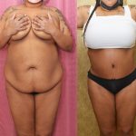 African American Tummy Tuck (Abdominoplasty) Before & After Patient #14090