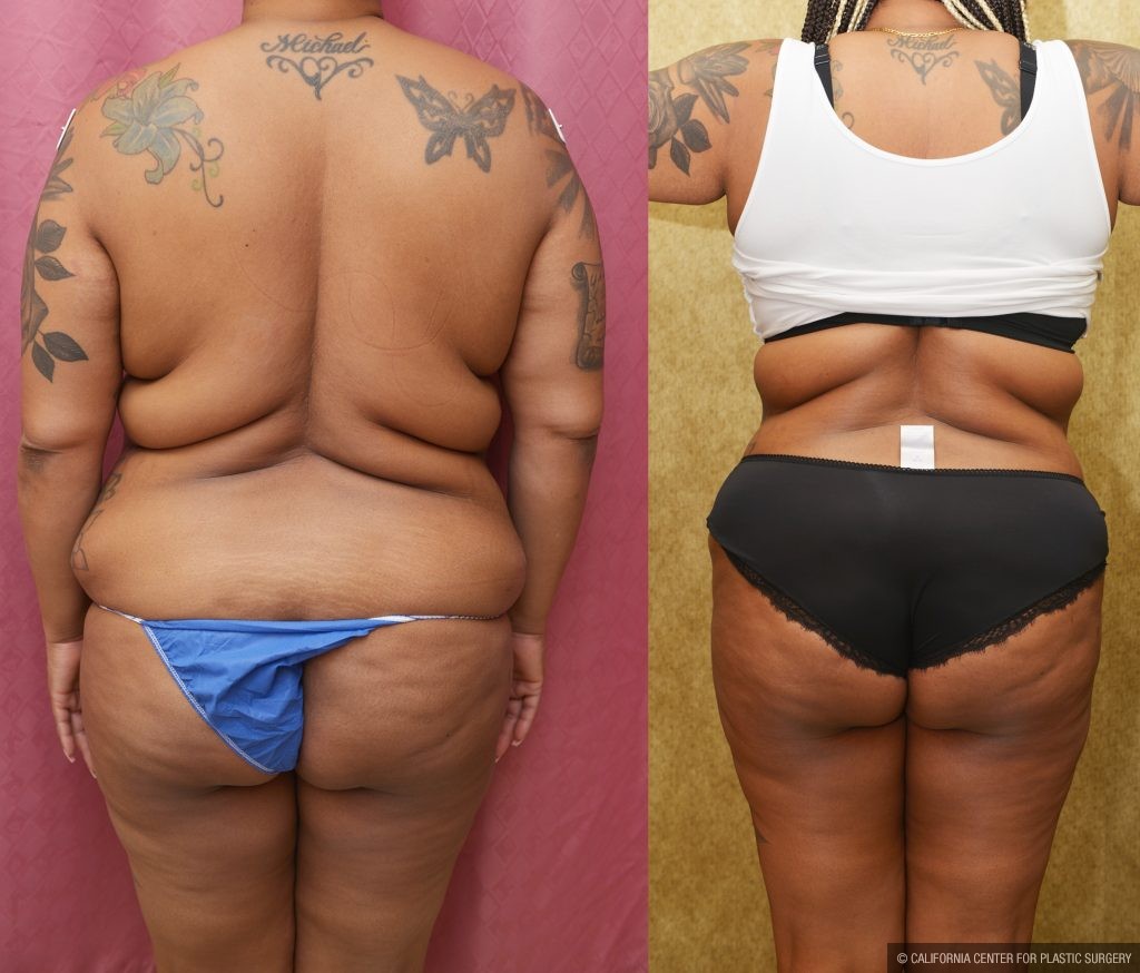 African American Tummy Tuck (Abdominoplasty) Before & After Patient #14090