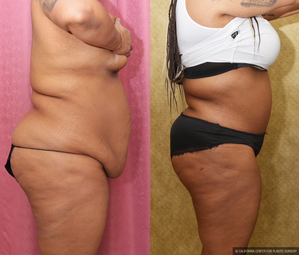 African American Tummy Tuck (Abdominoplasty) Before & After Patient #14090