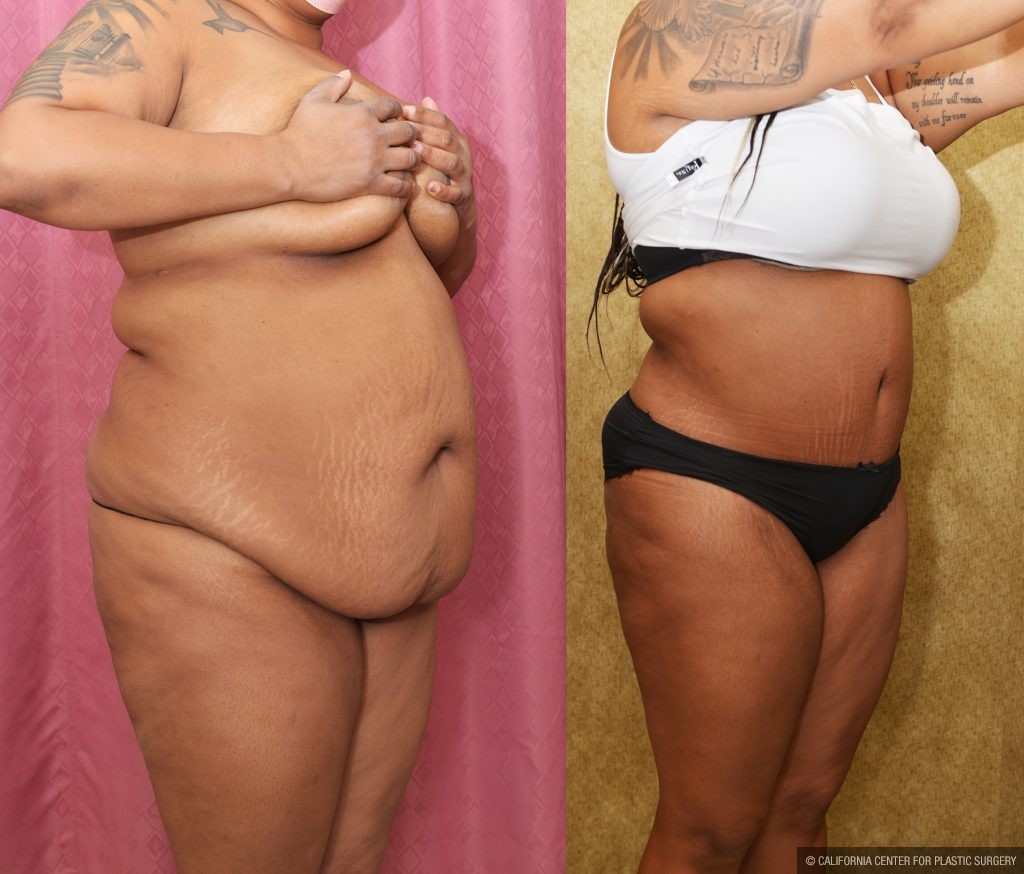 African American Tummy Tuck (Abdominoplasty) Before & After Patient #14090