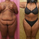 Tummy Tuck (Abdominoplasty) Plus Size Before & After Patient #14095