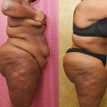 Tummy Tuck (Abdominoplasty) Plus Size Before & After Patient #14095