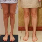 Calf Augmentation Before & After Patient #14112