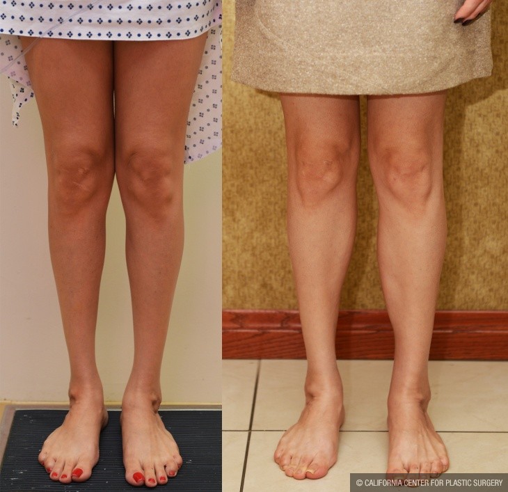 Calf Augmentation Before & After Patient #14112