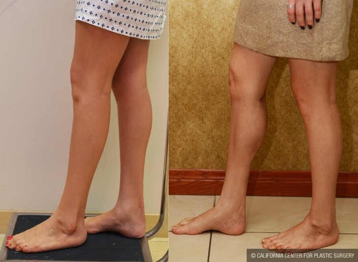 Calf Augmentation Before & After Patient #14112