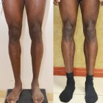 Calf Augmentation Before & After Patient #14115