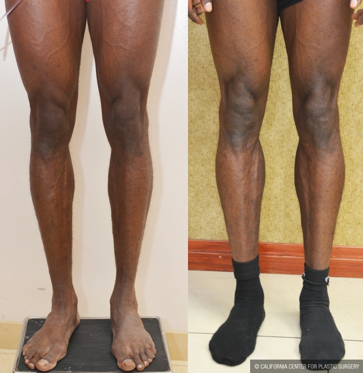 Calf Augmentation Before & After Patient #14115