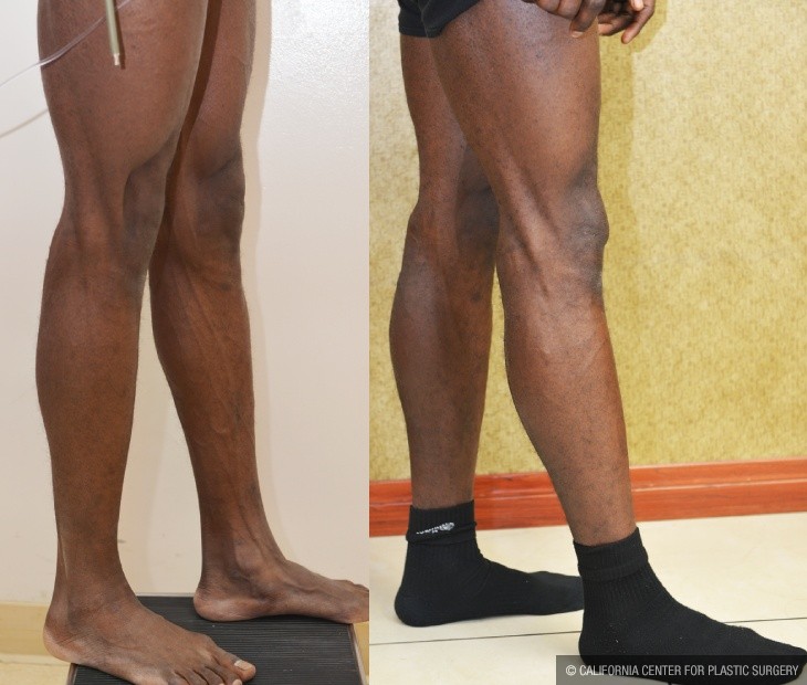 Calf Augmentation Before & After Patient #14115