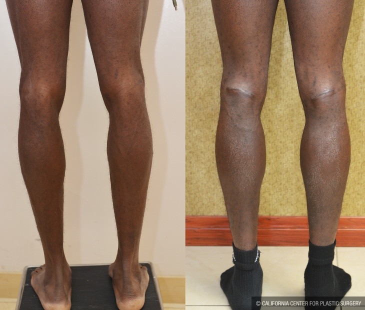 Calf Augmentation Before & After Patient #14115