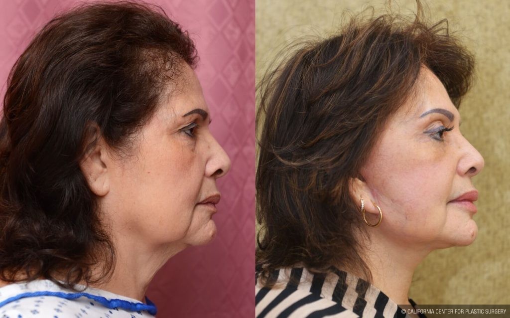 Facelift Before & After Patient #14102