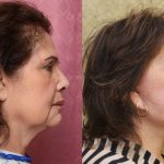 Facelift Before & After Patient #14102