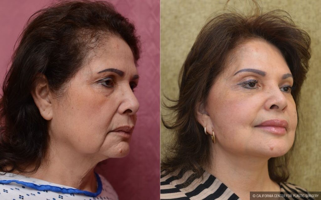 Facelift Before & After Patient #14102