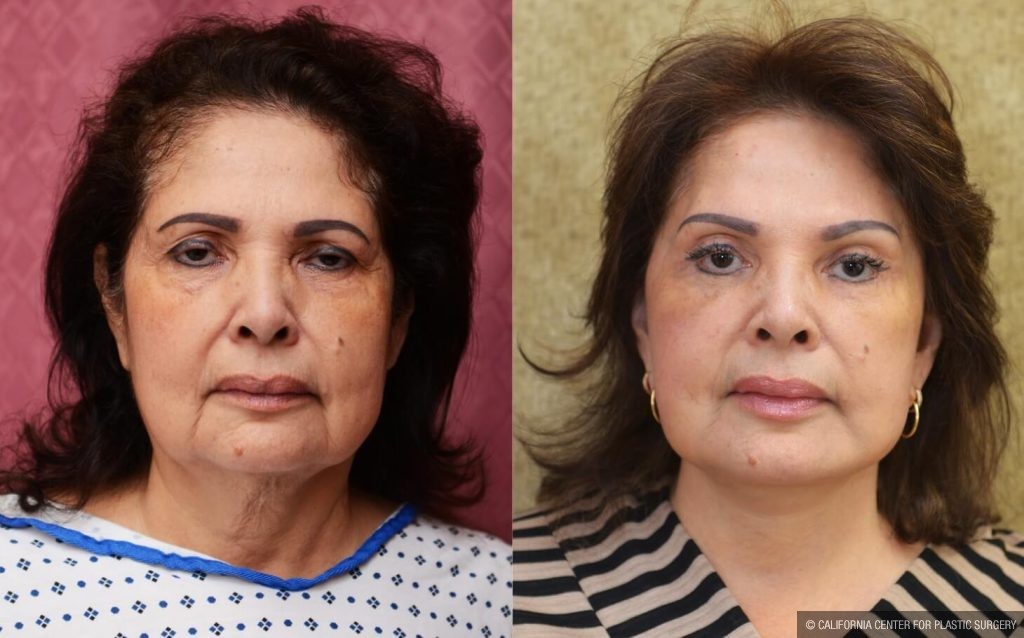 Facelift Before & After Patient #14102