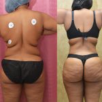 Tummy Tuck (Abdominoplasty) Small Size Before & After Patient #14107