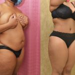 Tummy Tuck (Abdominoplasty) Small Size Before & After Patient #14107