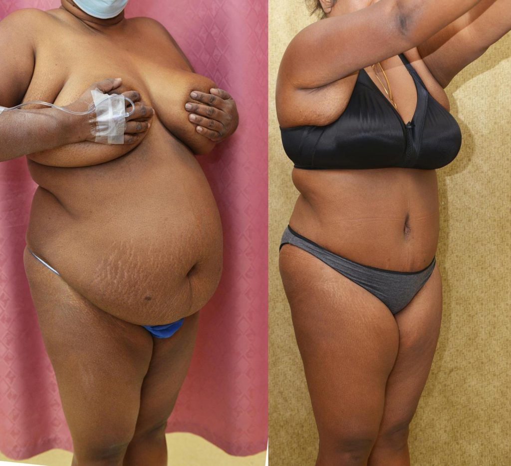 African American Tummy Tuck (Abdominoplasty) Before & After Patient #14106