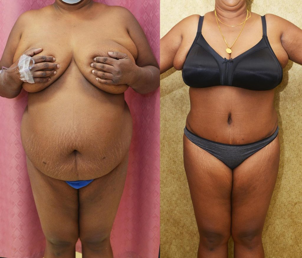 African American Tummy Tuck (Abdominoplasty) Before & After Patient #14106