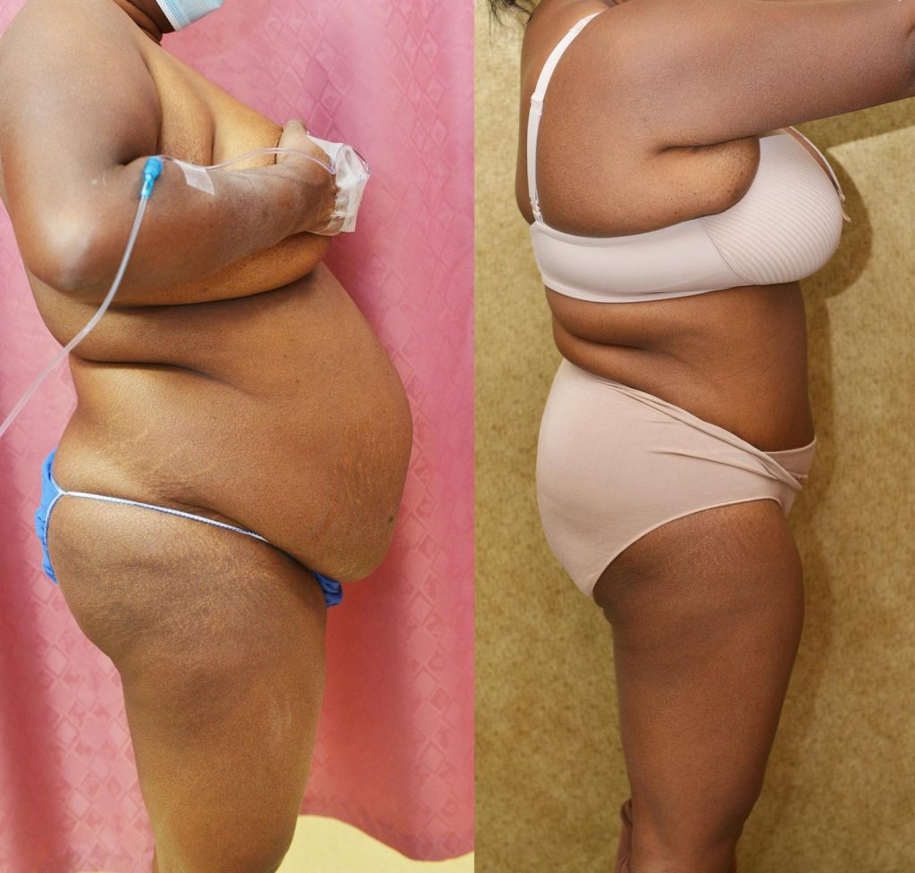 African American Tummy Tuck (Abdominoplasty) Before & After Patient #14106