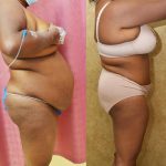 African American Tummy Tuck (Abdominoplasty) Before & After Patient #14106