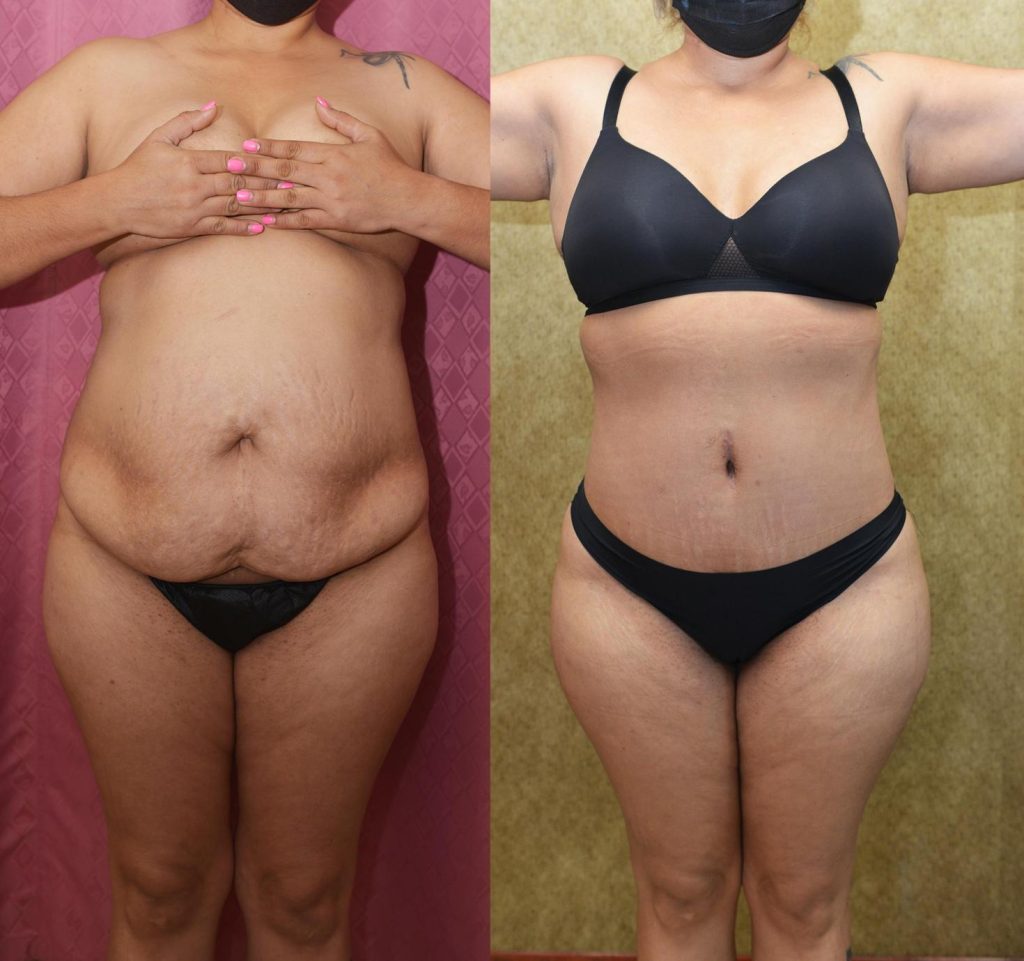 Tummy Tuck (Abdominoplasty) Small Size Before & After Patient #14089