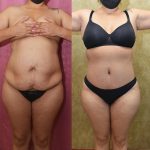 Tummy Tuck (Abdominoplasty) Small Size Before & After Patient #14089