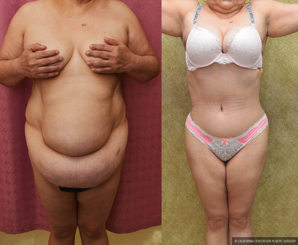 Tummy Tuck (Abdominoplasty) Plus Size Before & After Patient #14156