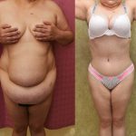 Tummy Tuck (Abdominoplasty) Plus Size Before & After Patient #14156