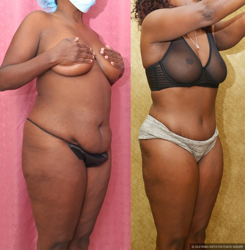 African American Tummy Tuck (Abdominoplasty) Before & After Patient #14155