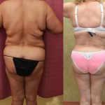 Tummy Tuck (Abdominoplasty) Plus Size Before & After Patient #14156