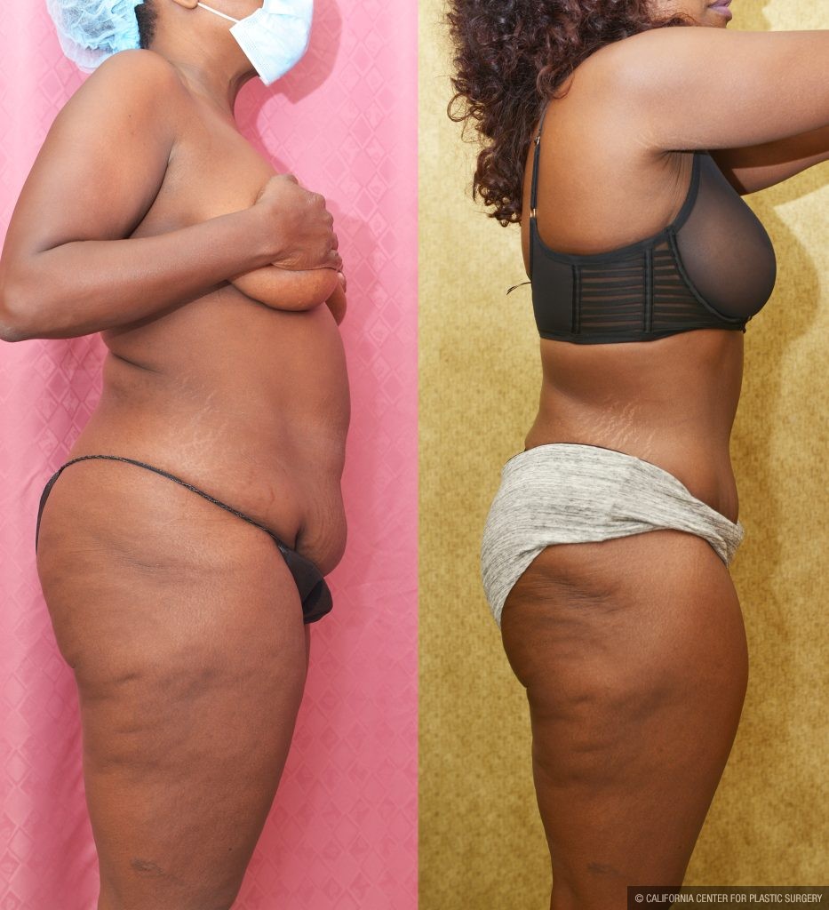 African American Tummy Tuck (Abdominoplasty) Before & After Patient #14155