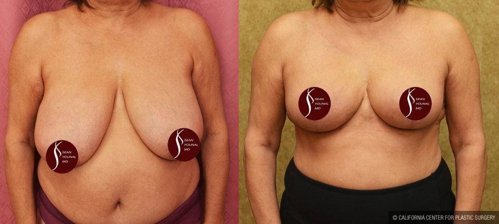 Breast Reduction Before & After Patient #14259