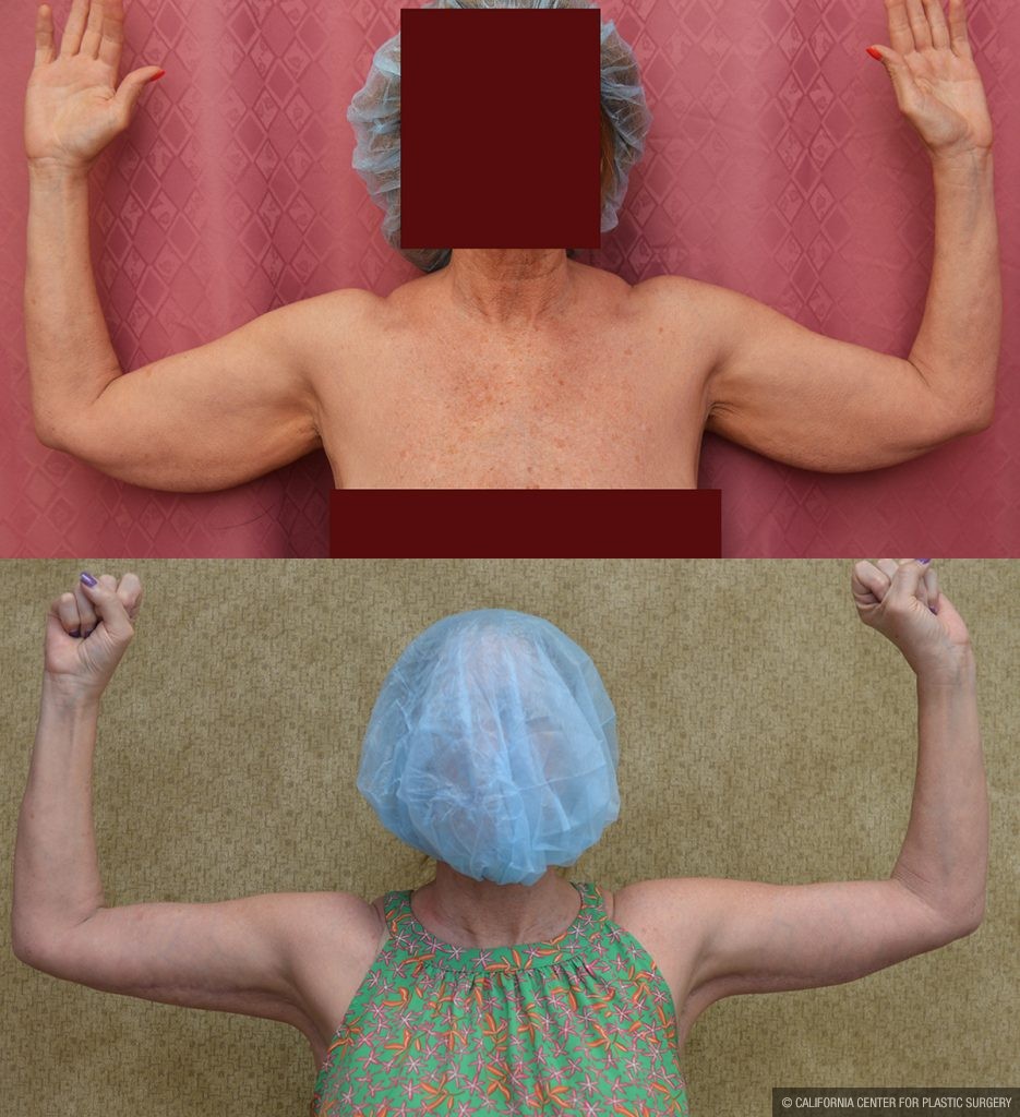 Arm Lift (Brachioplasty) Before & After Patient #14261