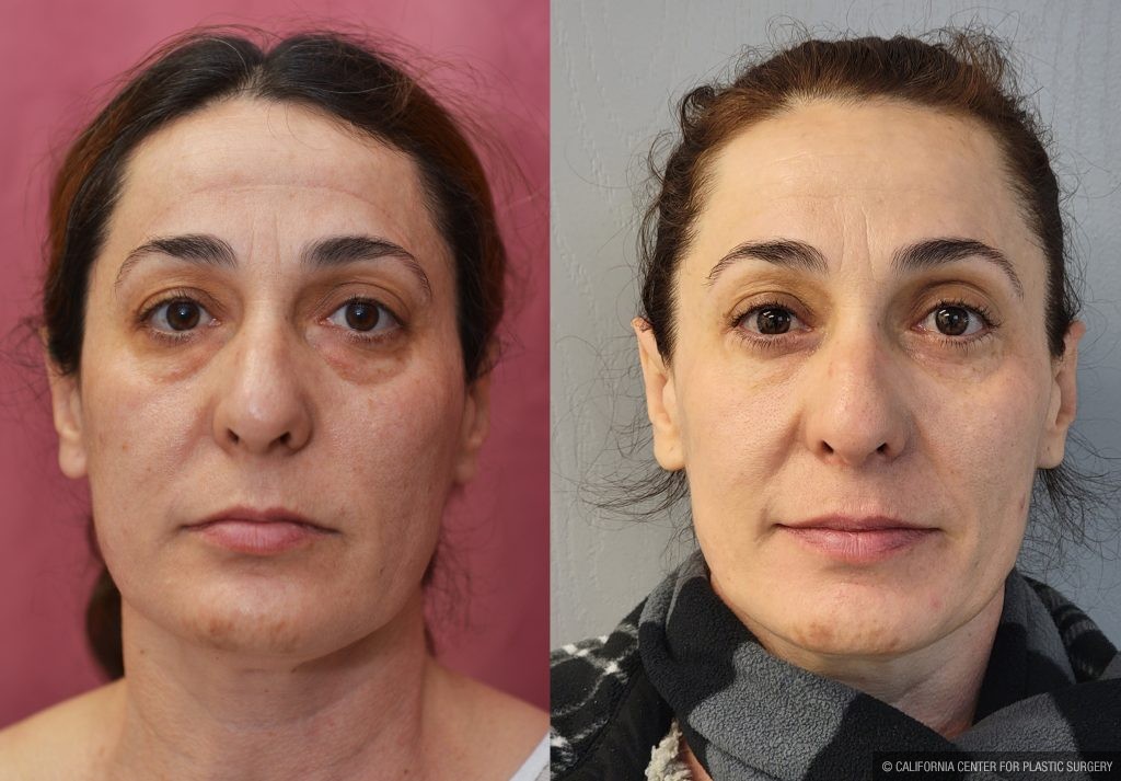 Eyelid (Blepharoplasty) Before & After Patient #14262