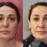 Eyelid (Blepharoplasty) Before & After Patient #14262