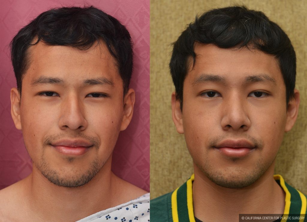 Rhinoplasty - Asian Before & After Patient #14264