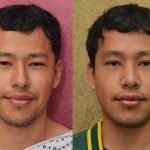 Rhinoplasty - Asian Before & After Patient #14264