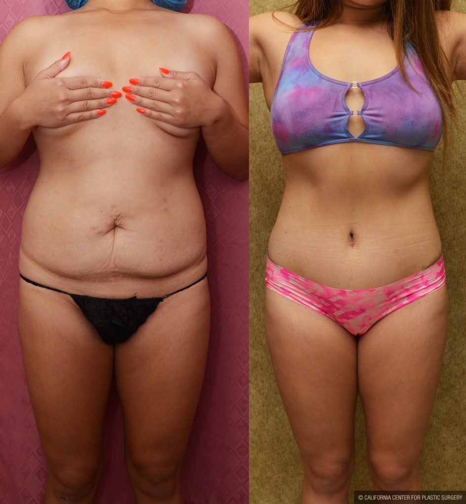 Tummy Tuck (Abdominoplasty) Medium Size Before & After Patient #14265