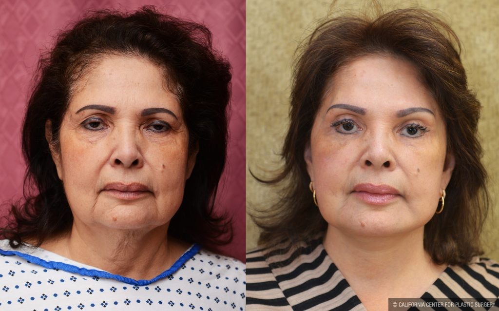 Eyelid (Blepharoplasty) Before & After Patient #14263