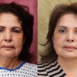 Eyelid (Blepharoplasty) Before & After Patient #14263