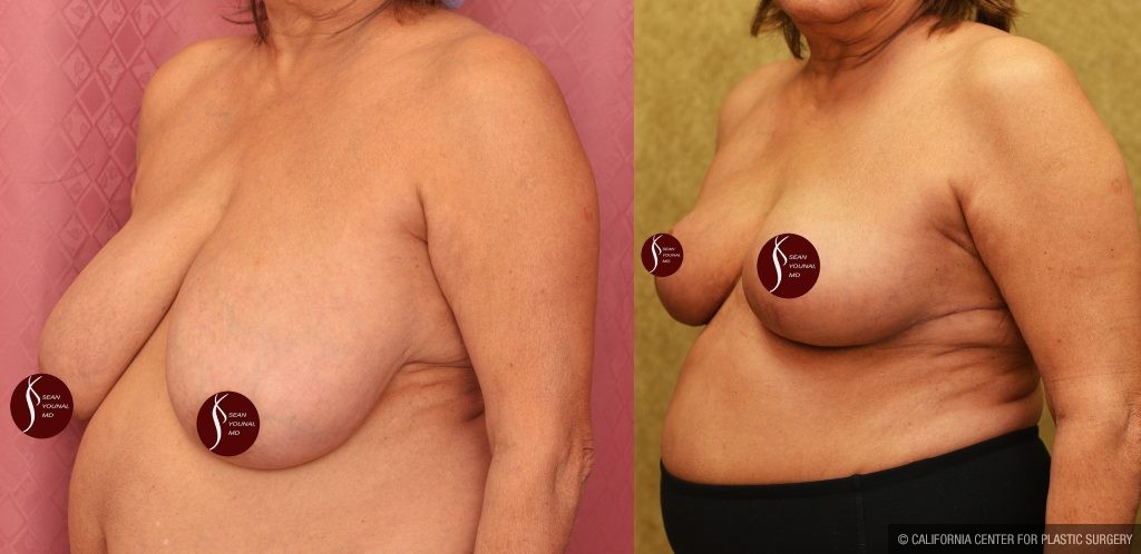 Breast Reduction Before & After Patient #14259