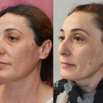 Eyelid (Blepharoplasty) Before & After Patient #14262