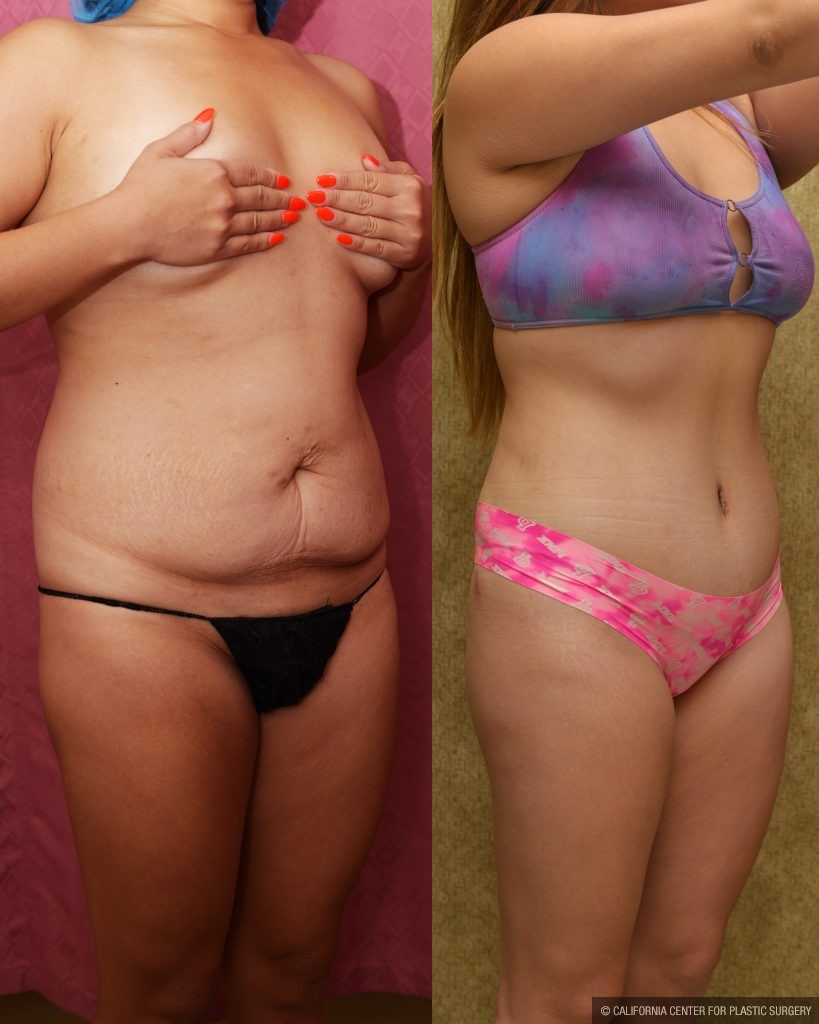 Tummy Tuck (Abdominoplasty) Medium Size Before & After Patient #14265