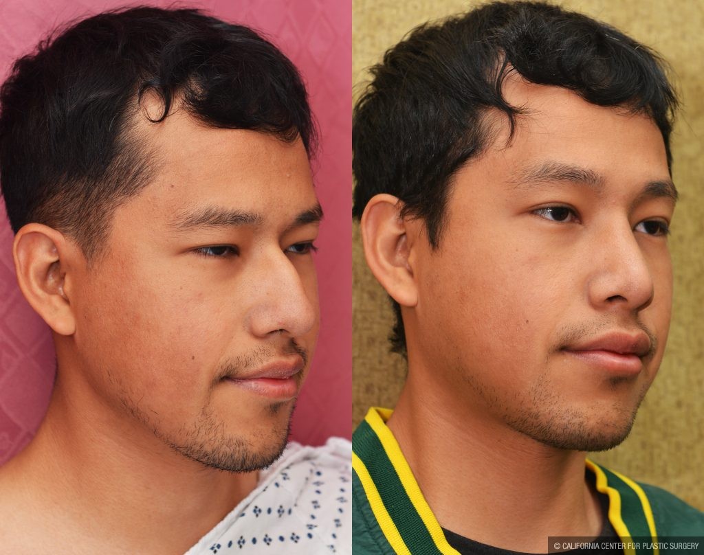 Rhinoplasty - Asian Before & After Patient #14264