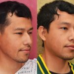 Rhinoplasty - Asian Before & After Patient #14264