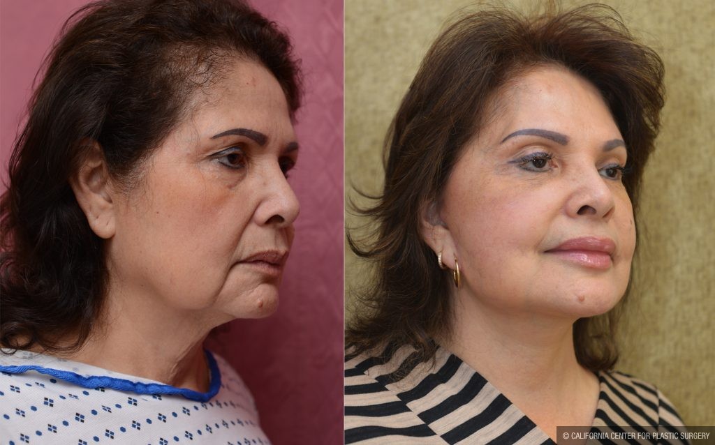 Eyelid (Blepharoplasty) Before & After Patient #14263