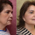 Eyelid (Blepharoplasty) Before & After Patient #14263