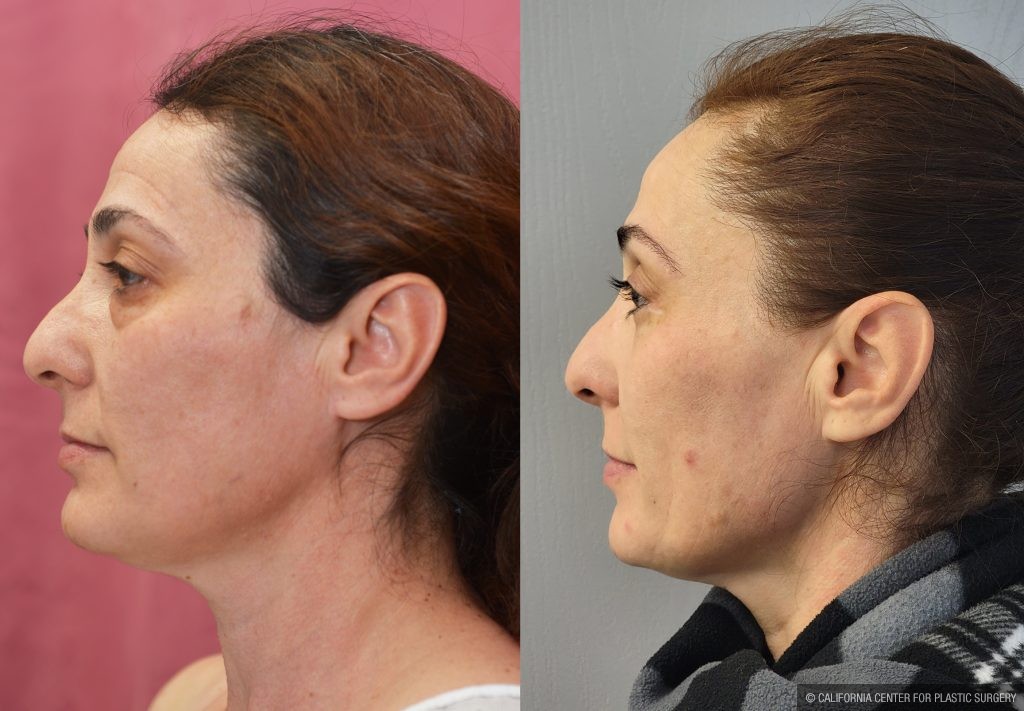 Eyelid (Blepharoplasty) Before & After Patient #14262